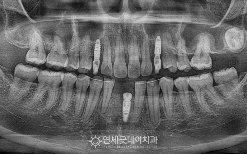 20대임플란트 치유 지대주 연결