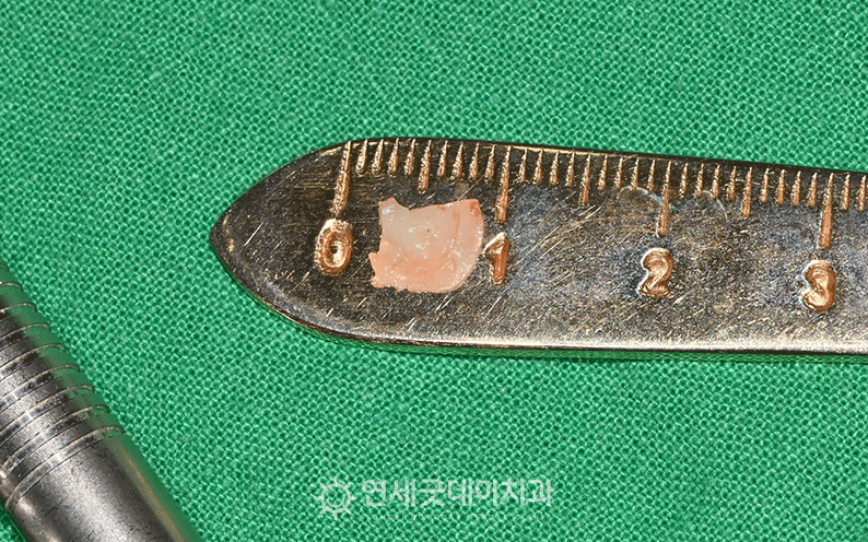 20대임플란트 잇몸이식수술 병행