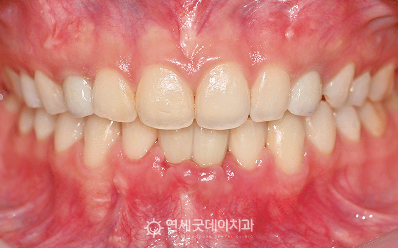 20대임플란트 치료 후 모습