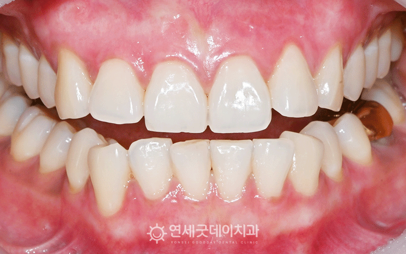 잇몸미백 시술 후 모습