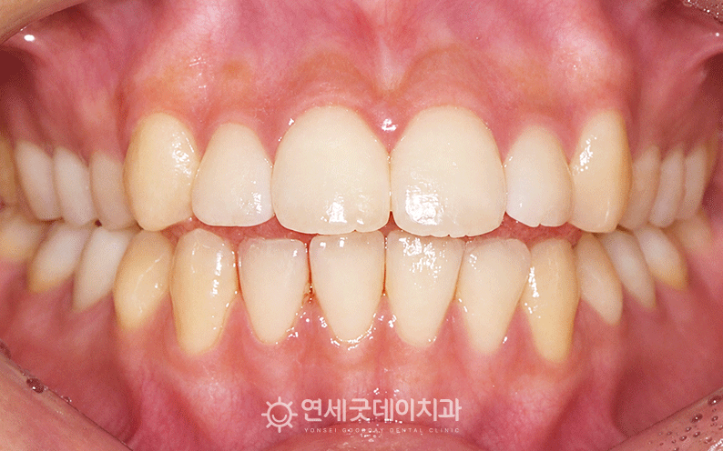 20대 오픈바이트 모습