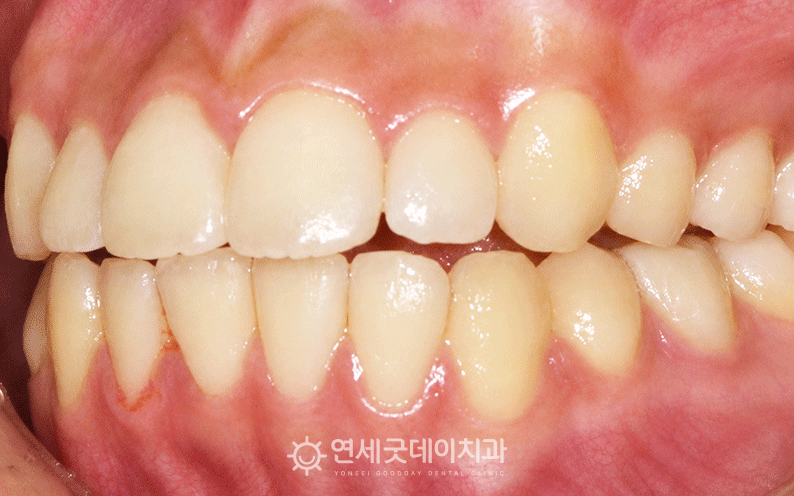 20대 오픈바이트 왼쪽 모습