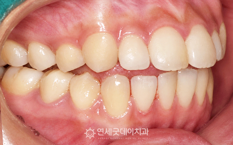 20대 오른쪽 모습