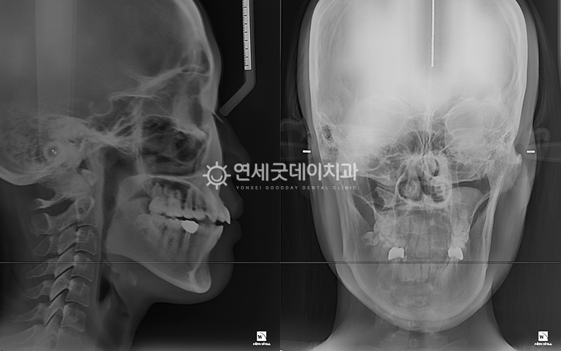 20대 오픈바이트 엑스레이 촬영