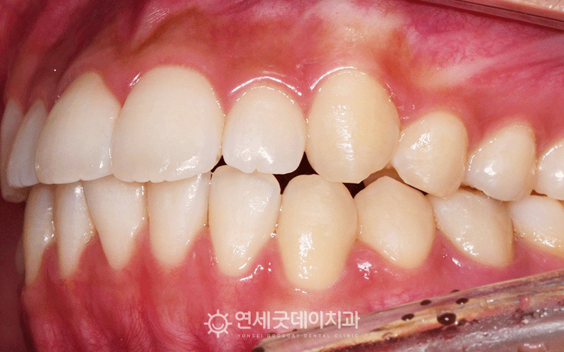 과개교합 치료 중 사진