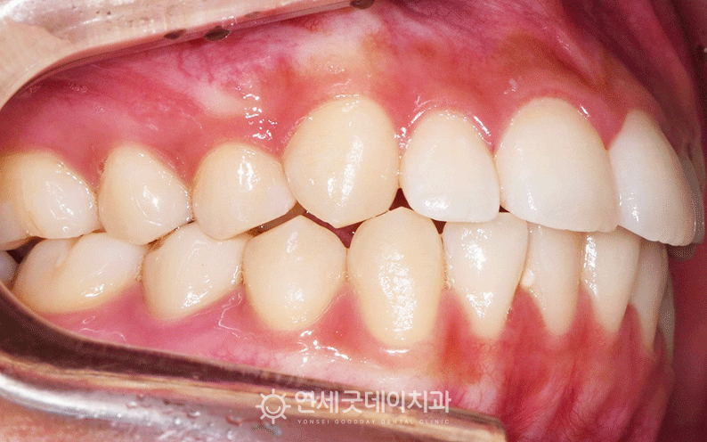 오픈바이트 교정 치료 중 사진
