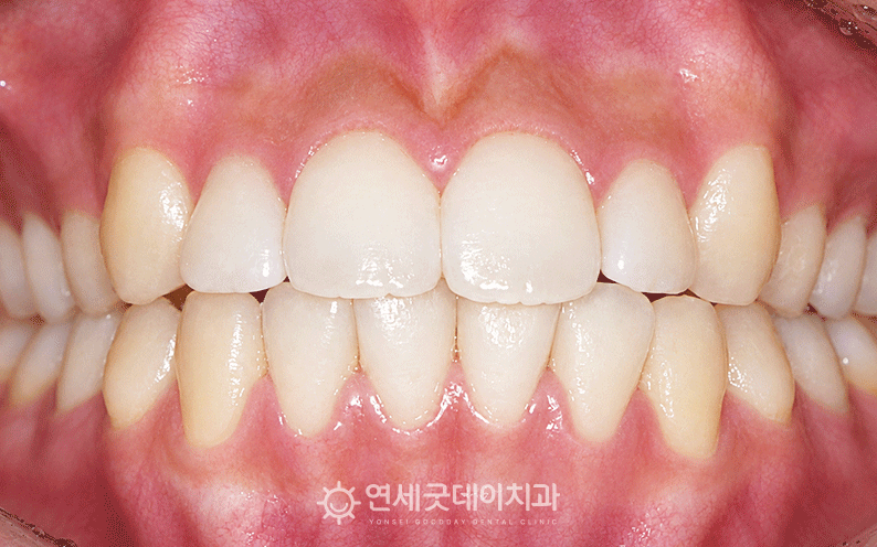 오픈바이트 치료 중 사진