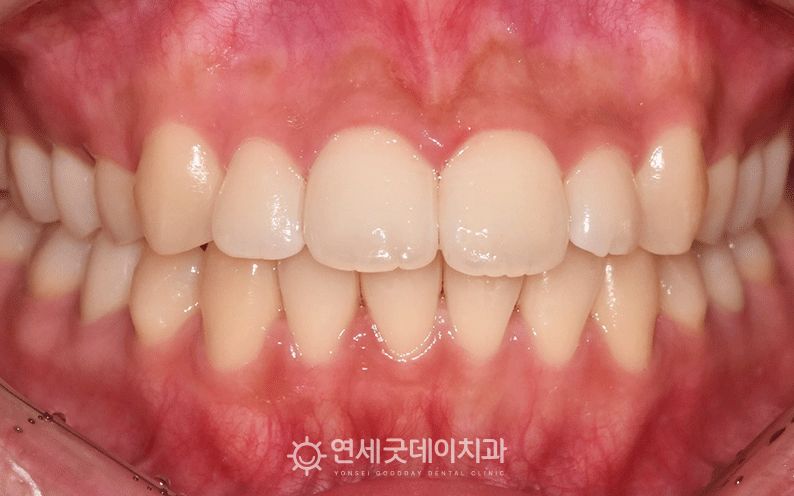 오픈바이트 치료 중 사진