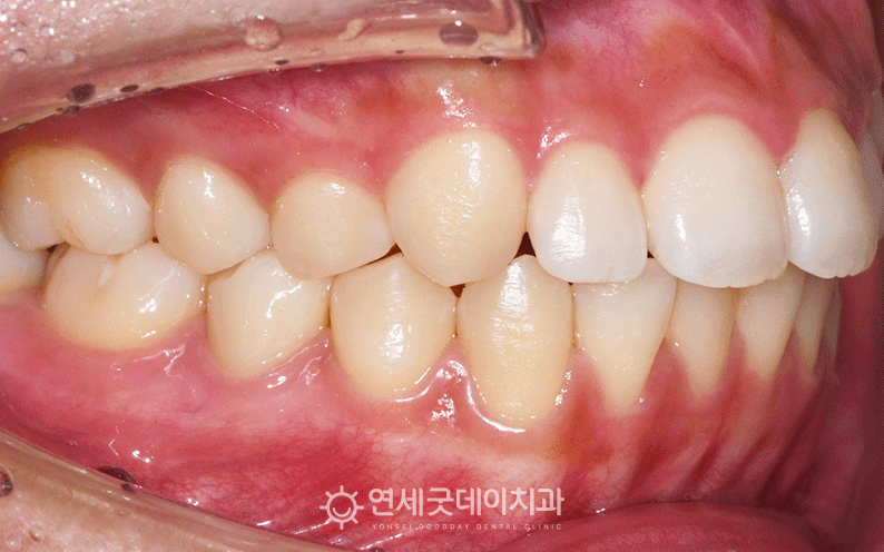 턱관절통증치료 중 사진