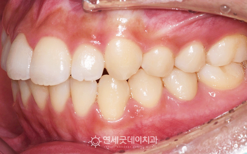 턱관절장애 치료 중 사진