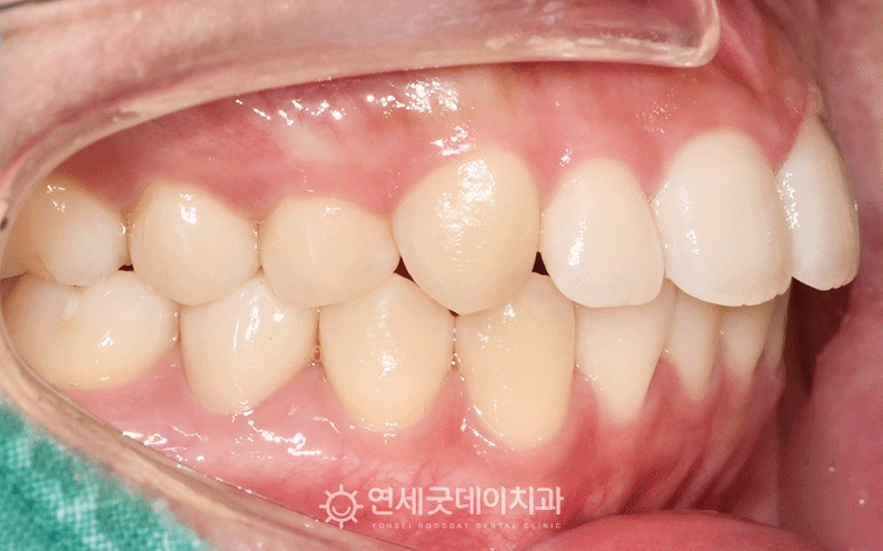 오픈바이트 치료 완료