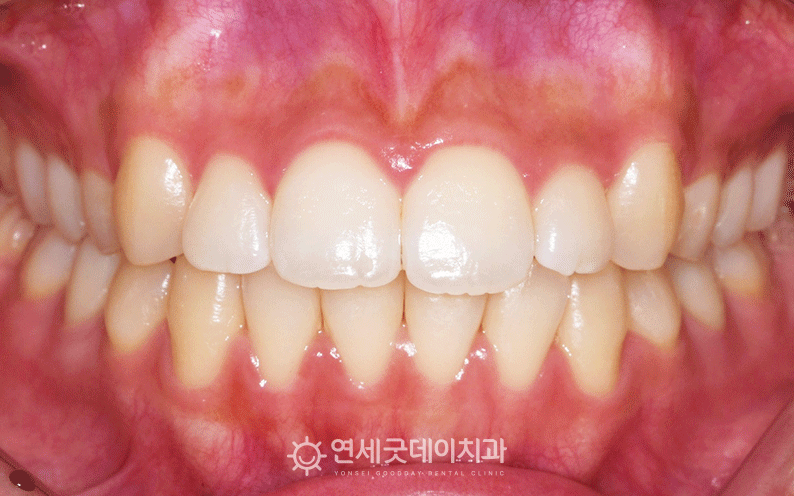 과개교합 오픈바이트 치료 완료
