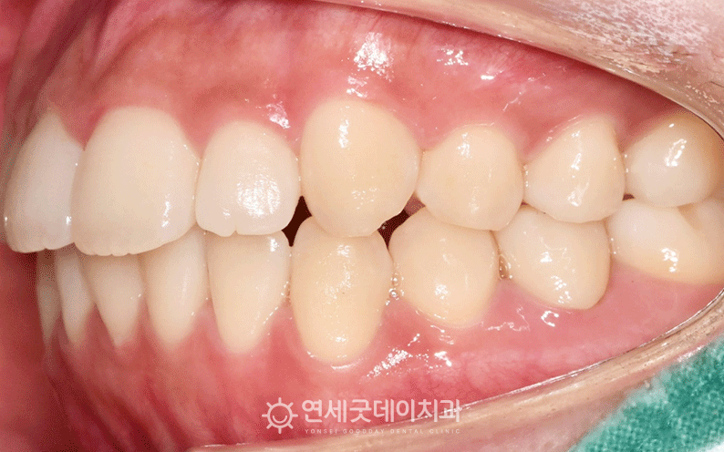 과개교합 치료 완료