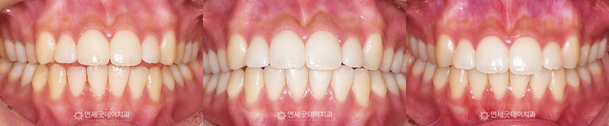 과개교합 오픈바이트 치료 전후