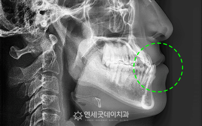 부정교합 3급 모습