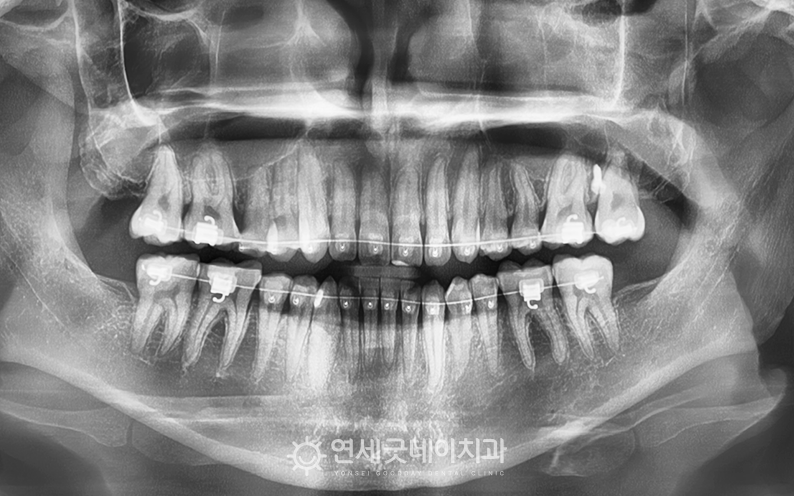 양악수술 전 교정치료 시작하는 모습