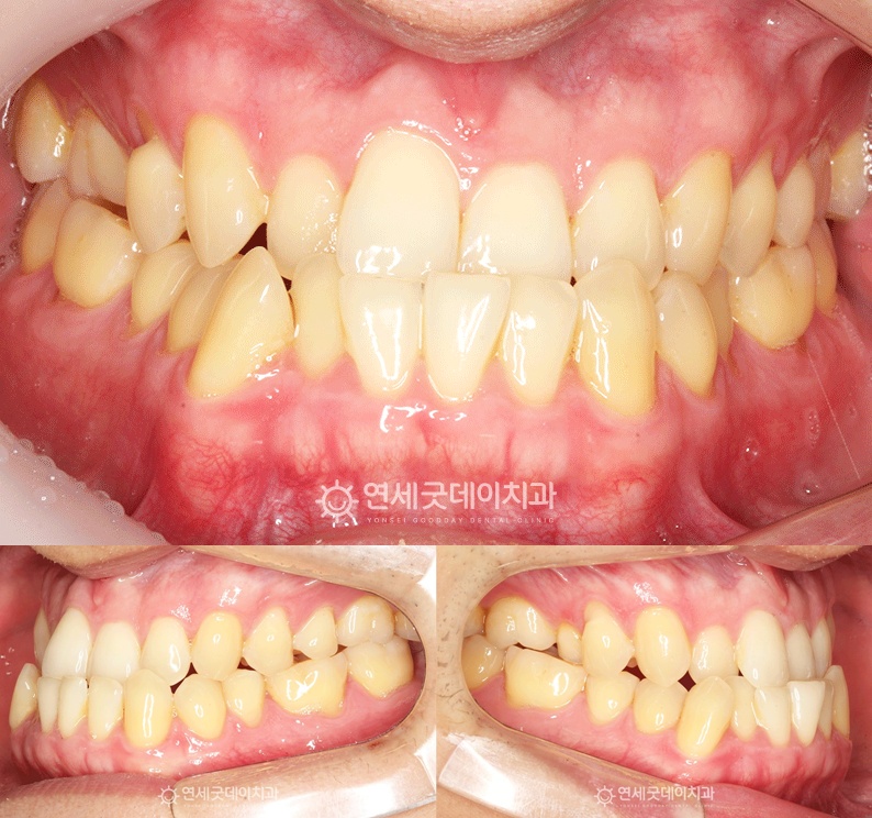 부정교합 3급 반대교합 모습