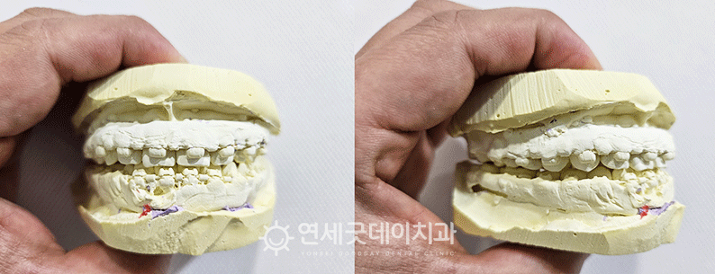 치아 교정후 본 뜬 모습