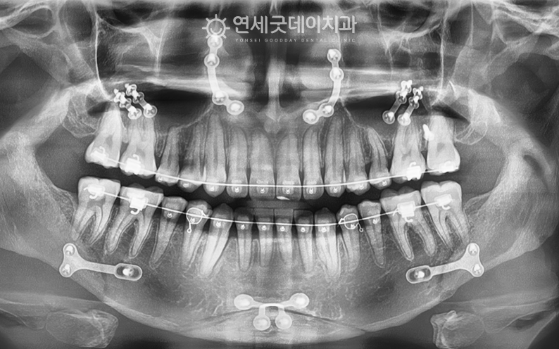 양악수술 후 치아교정 진행하는 모습