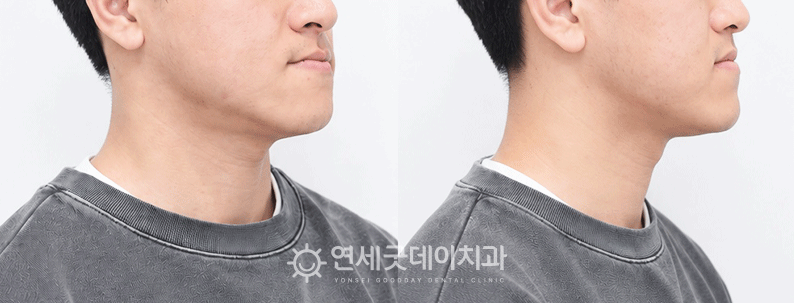 주걱턱교정 전 모습