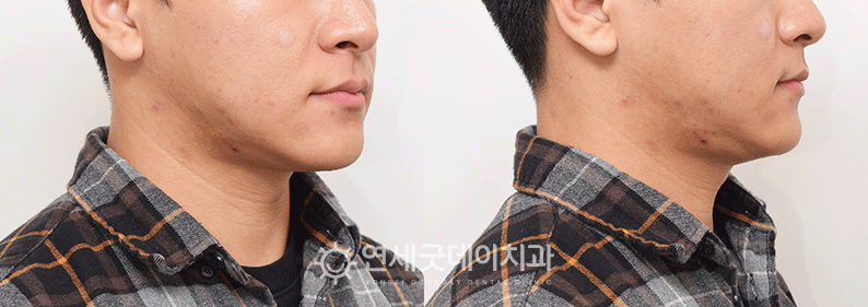 주걱턱교정 후 모습